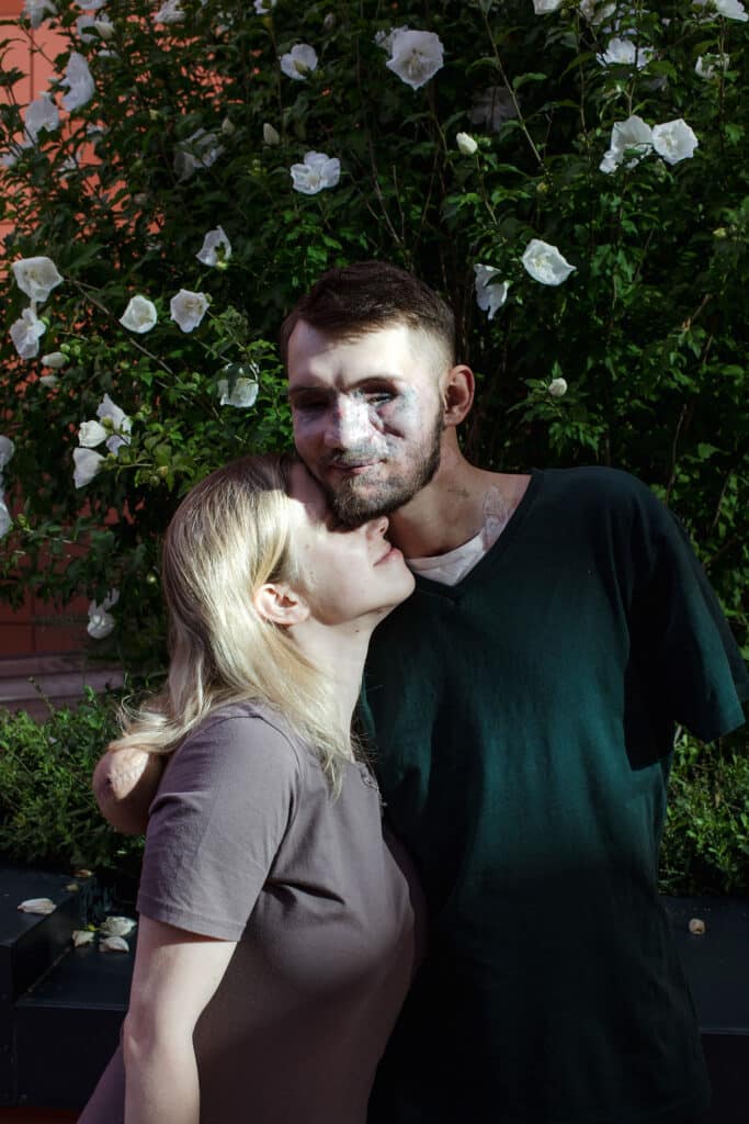 August 1, 2023. Andriy Smolensky and Alina Smolenska pose for a photo outside of the Kyiv Hospital where he has just had his 16th surgery to repair his hearing after a mortar shell exploded I his face while leading a drone reconnaissance unit in Eastern Ukraine, destroying his hands and eyes and severely damaging his ears. As they begin the long journey towards recovery, Alina says she is more relieved that he is alive than anything, and Andriy expresses worry for the many young men who will meet fates like his or worse. © Natalie Keyssar